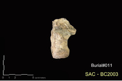 คำบรรยายภาพ : ภาพด้านบน กระดูกข้อเท้า calcaneus ซ้าย