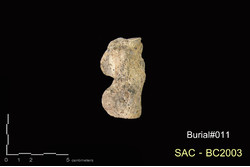 คำบรรยายภาพ : ภาพด้านล่าง (ฝ่าเท้า) กระดูกข้อเท้า calcaneus ซ้าย