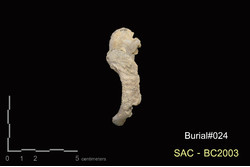 คำบรรยายภาพ : ภาพด้านใกล้กลาง กระดูกเชิงกรานซ้าย บริเวณ pubis symphysis