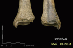 คำบรรยายภาพ : ภาพด้านหน้า ปลายกระดูกหน้าแข้งซ้ายและขวา บริเวณ squatting facet