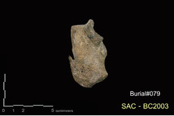 คำบรรยายภาพ : ภาพด้านไกลกลาง กระดูกข้อเท้า calcaneus ขวา